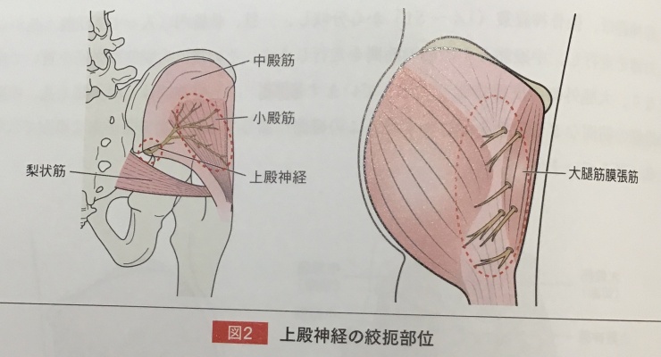 長引くお尻の痛みの解決策